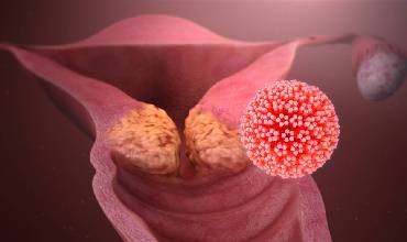 علائم HPV در زنان چیست؟